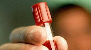 كيفية الاستعداد لاختبارات التهاب الكبد؟
